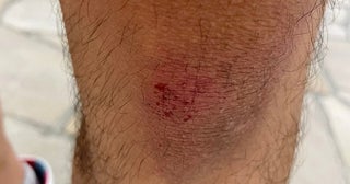 だいたひかるの夫、転倒し爪下血腫になった足の指「痛々しい」「お大事に」の声