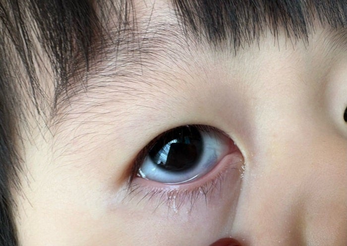 【写真・画像】 あいのり・桃、以前から気になっていた長男の目の症状「結構大きめの青あざが」 　1枚目