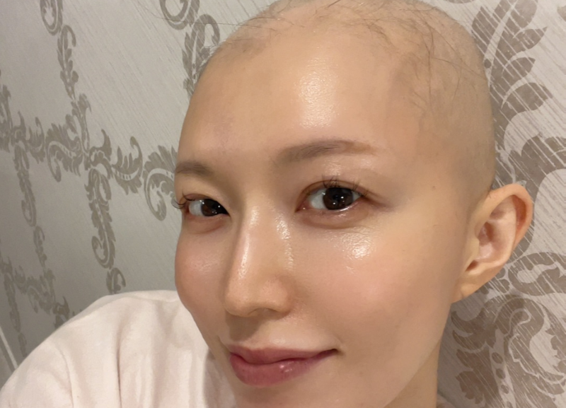 【画像】抗がん剤治療中の脱毛事情を語る居原田麗さん