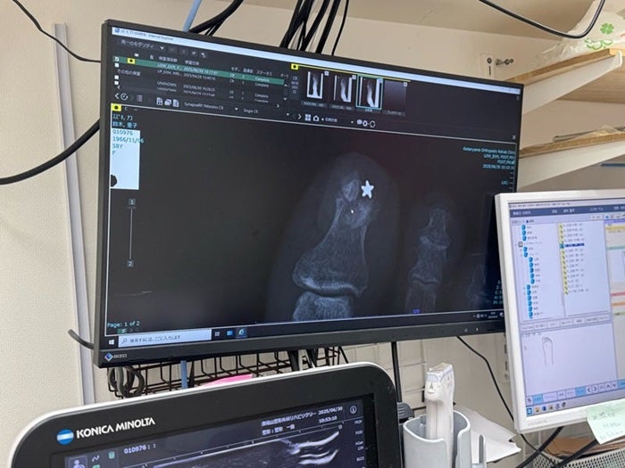 【写真・画像】 「腫れてます」エスカレーターを踏み外し転倒した結果「めでたく杖をついて歩く日々」 　1枚目