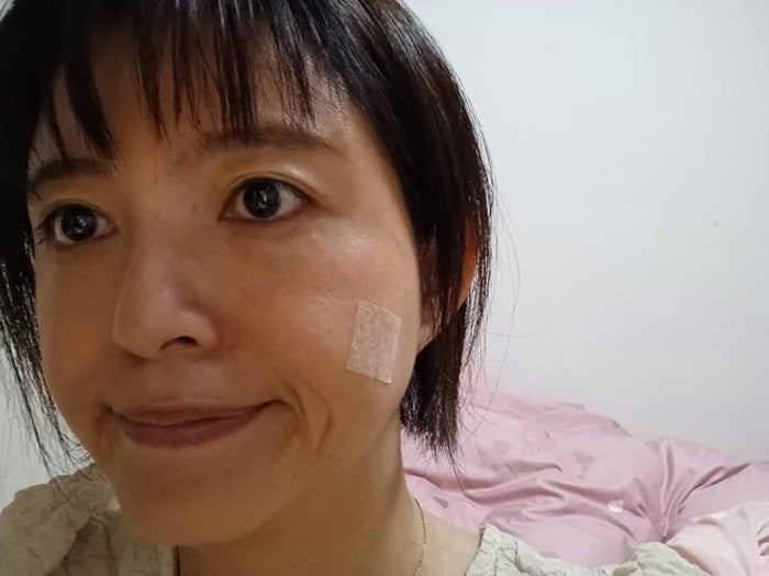 【写真・画像】 「抜糸のために病院へ」ほくろ除去手術後の経過を報告「1ヵ月程度テーピングが必要」 　1枚目