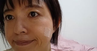 「抜糸のために病院へ」ほくろ除去手術後の経過を報告「1ヵ月程度テーピングが必要」