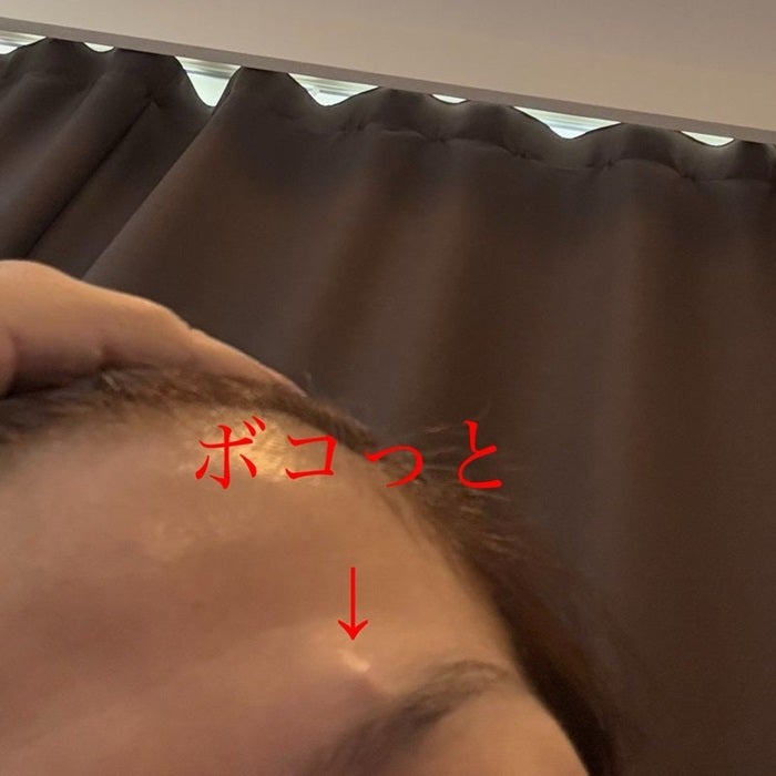 【写真・画像】 だいたひかる、眉毛の上にできたしこりを切除「気になっている事は、早めに対処した方が」 　1枚目