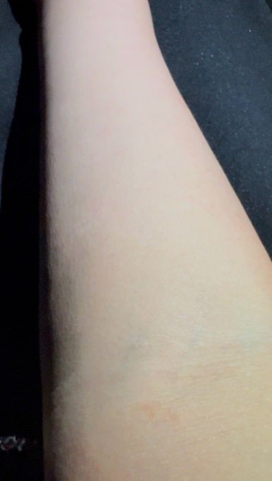 【写真・画像】 だいたひかる、今までで1番重症な蜂窩織炎の症状「細菌が全身にまわると、命にかかわる敗血症に」 　1枚目