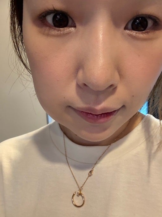 【写真・画像】 「これは現実か？」親知らずを抜歯した翌朝の姿「鏡見てびっくり」 　1枚目