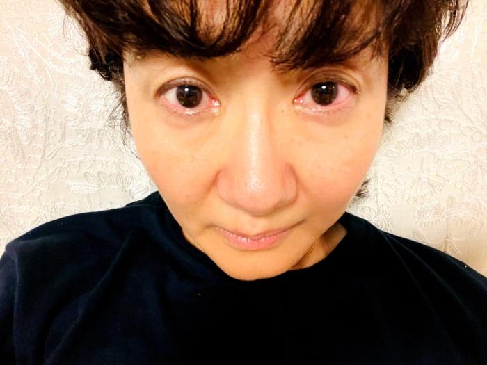 【写真・画像】 古村比呂、浮腫みと目の赤みが出ている自身の姿「お大事に」「大変ですね」の声 　1枚目
