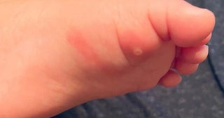 だいたひかる、手足口病などを疑った息子の症状「水ぶくれと腫れがあり」