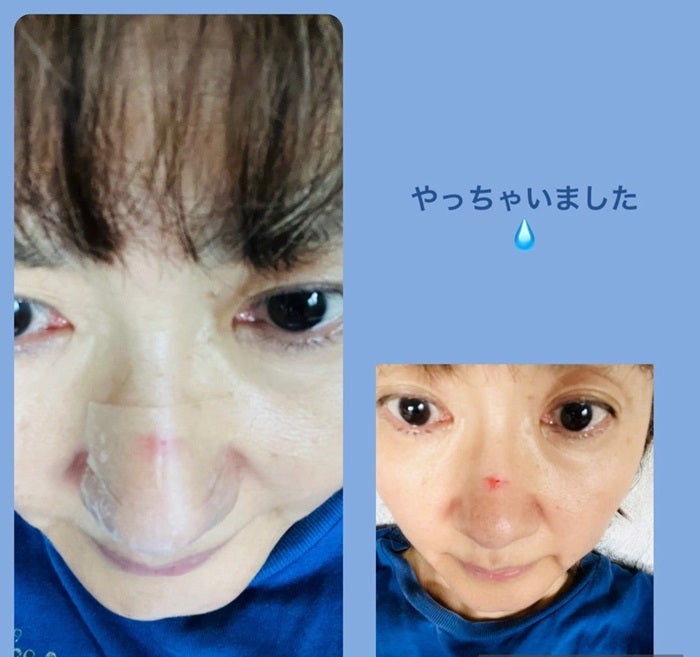 【写真・画像】 古村比呂、負傷した自身の顔の写真を公開「可哀想に」「痛そう」の声 　1枚目