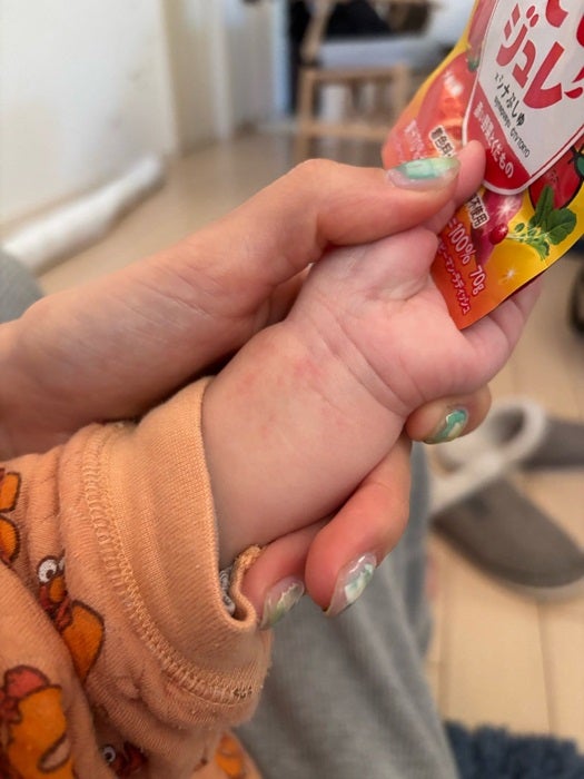 【写真・画像】 美優、次男の手首に謎の症状が出て病院を受診「手足口病でもないし、なんだろね…と」 　1枚目