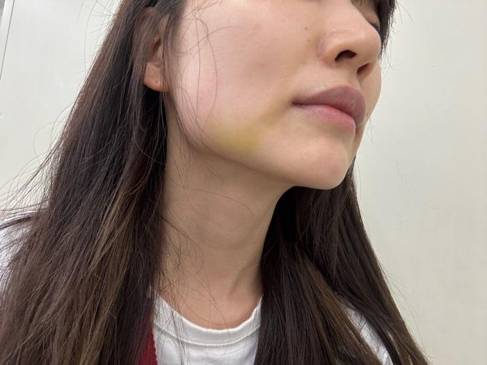  あいのり・桃、美容施術のダウンタイム中の自撮りショットを公開「顎横あたりが黄色くなってます」  1枚目