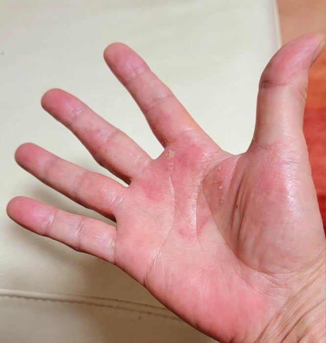 【写真・画像】 モト冬樹「もう何ヵ月もこうなんだけど」手の症状が続き皮膚科を受診「早く治るといいな」 　1枚目